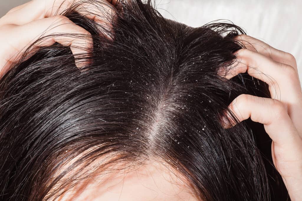 close up of flakes on a scalp