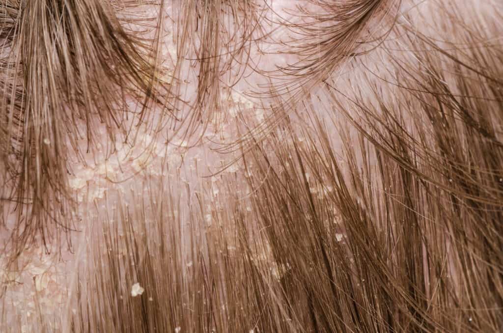 Dandruff in the hair of a person